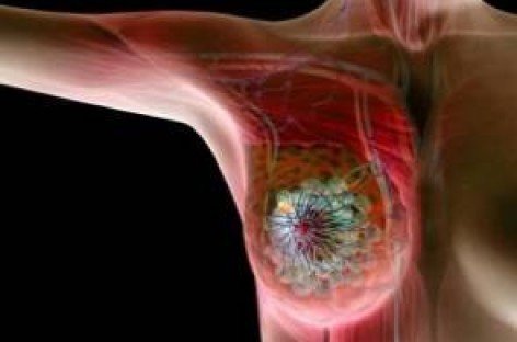 Важливо: світові показники раку грудей зросли