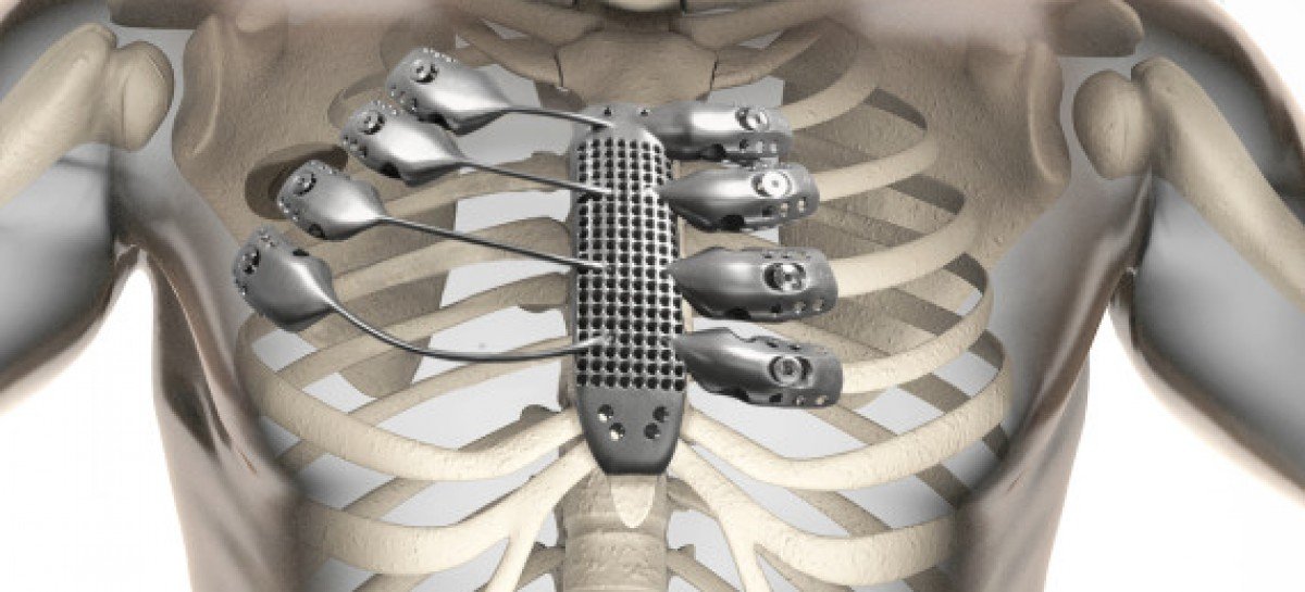 Чоловіку імплантували штучну грудну клітину, роздруковану на 3D-принтері