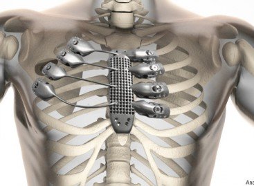 Чоловіку імплантували штучну грудну клітину, роздруковану на 3D-принтері
